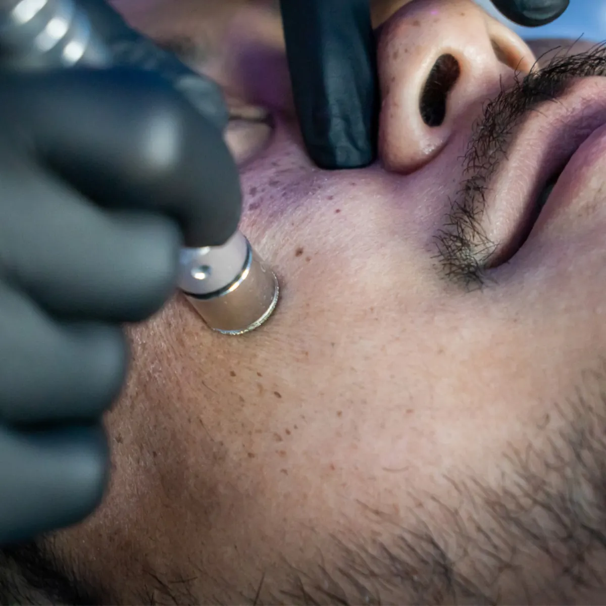 Microdermabrasion Facial
